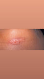 HSV1-2 natural herbs /ms,Hpv,AIDS,syphilis,hpv