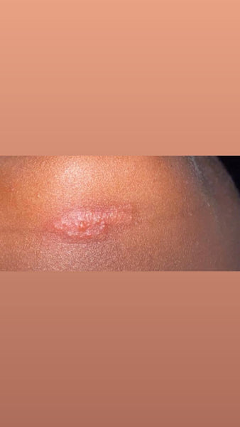 HSV1-2 natural herbs /ms,Hpv,AIDS,syphilis,hpv