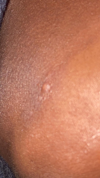 HSV1-2 natural herbs /Hpv,AIDS&syphilis